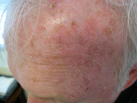 solar keratosis treatments - pictures, photos