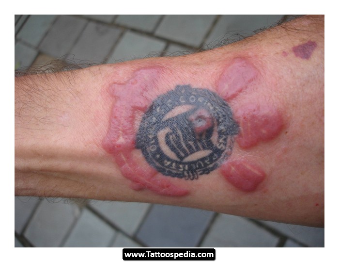 tattoo ink allergy pictures, photos