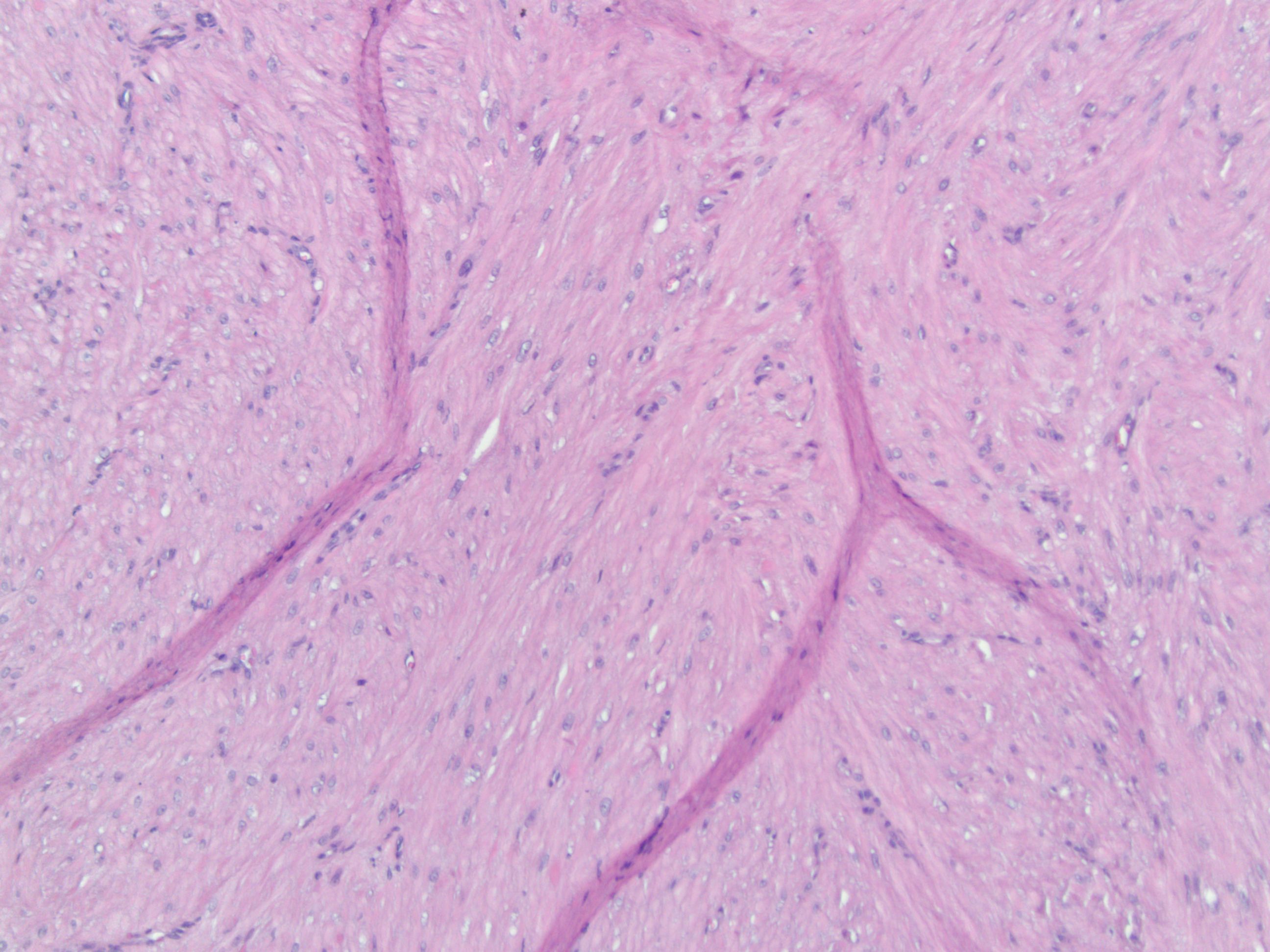 angioleiomyoma pictures, photos