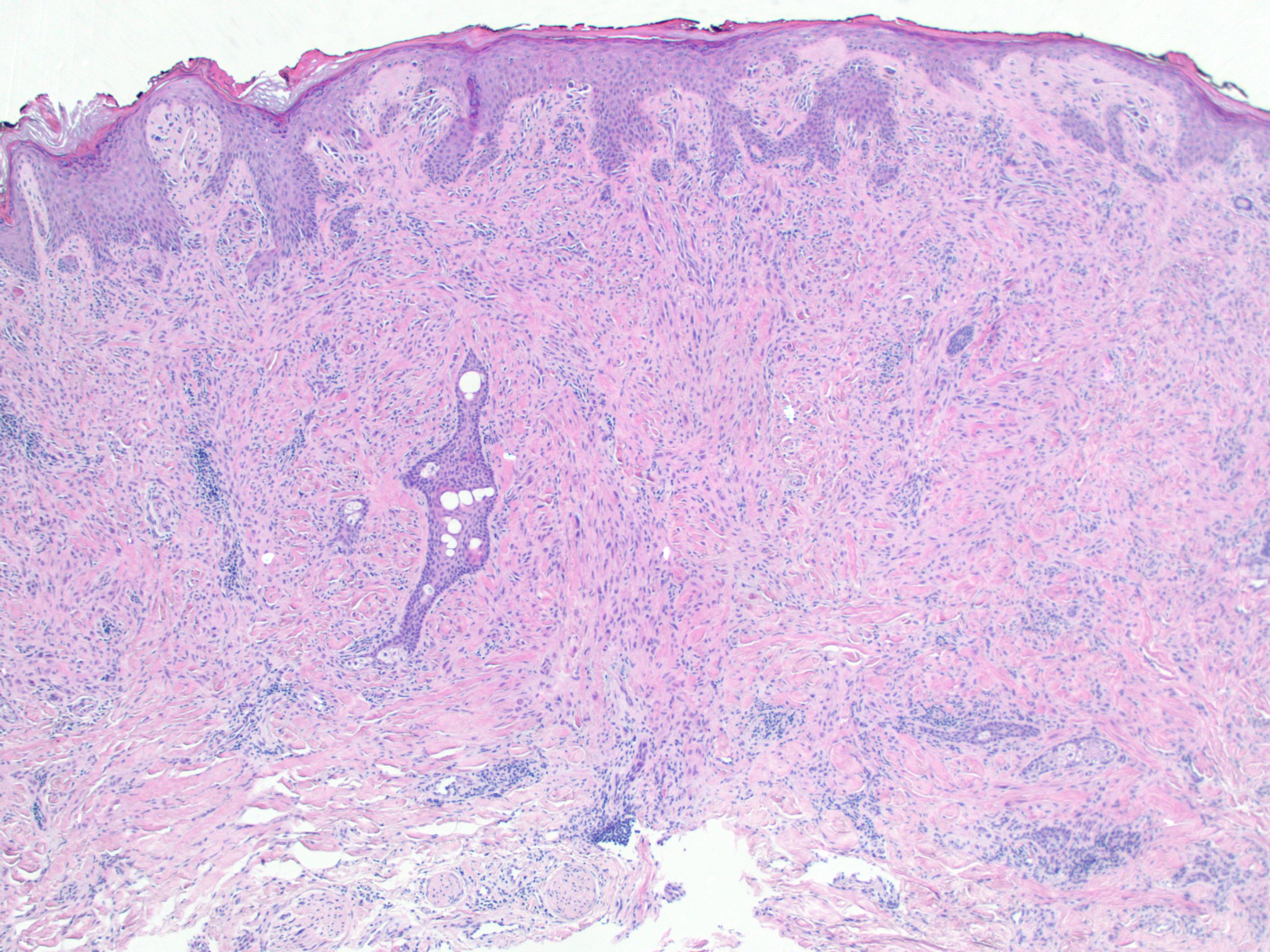 atypical spitz nevus icd 10