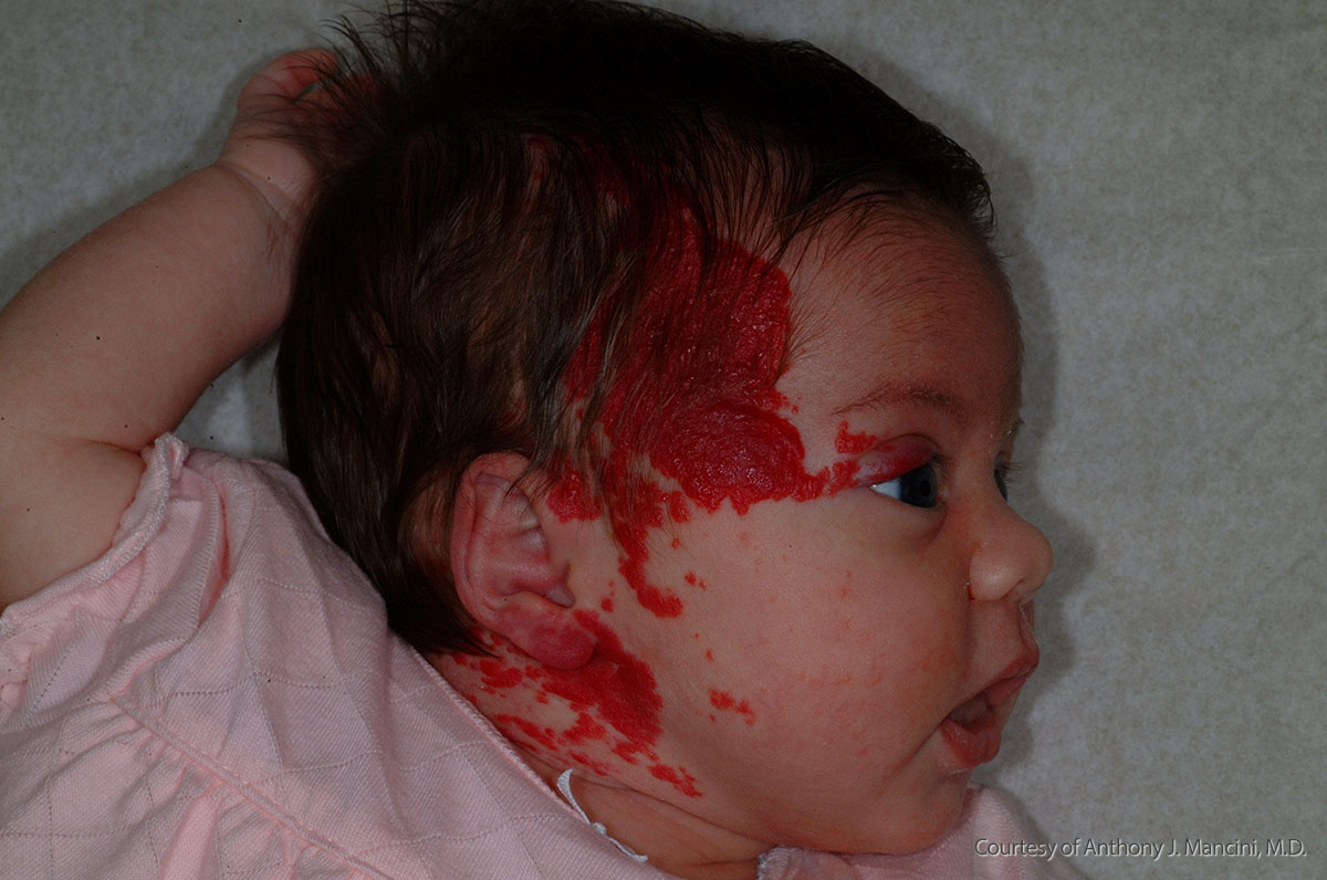 infant hemangioma - pictures, photos