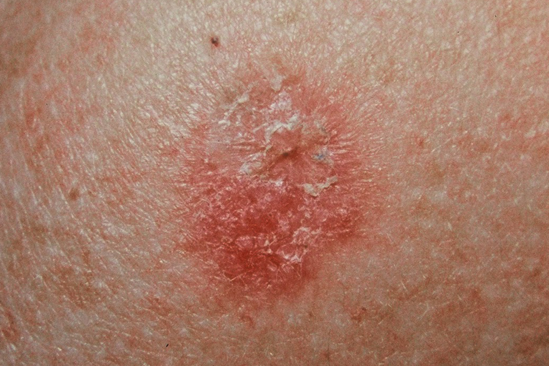 red-spots-on-skin-cancer