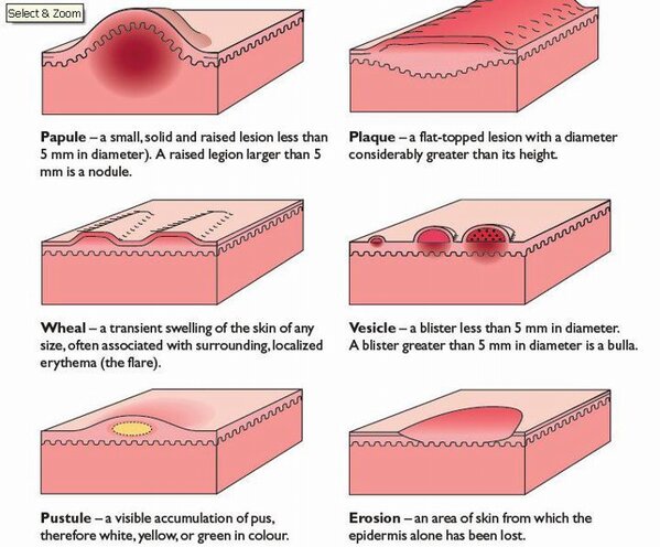 Terminology Of Skin Lesions Dermatology Medbullets