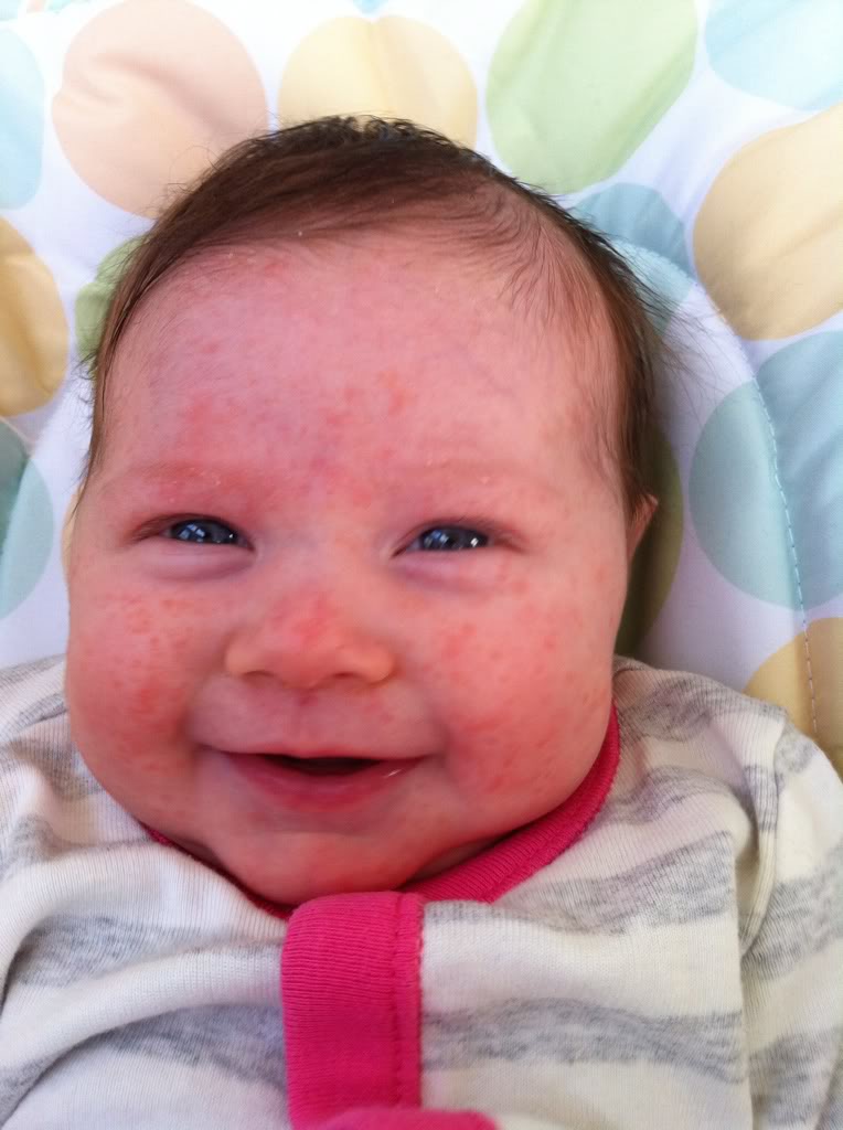 babies acne pictures, photos