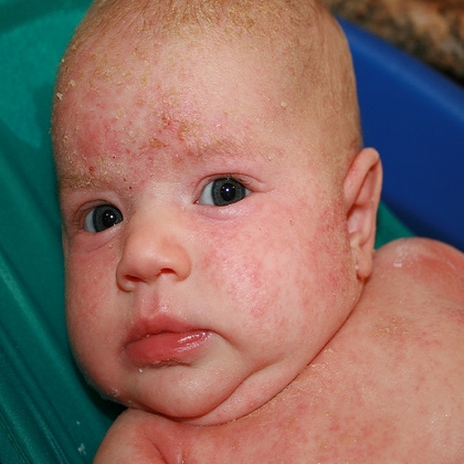 eczema in babies - pictures, photos