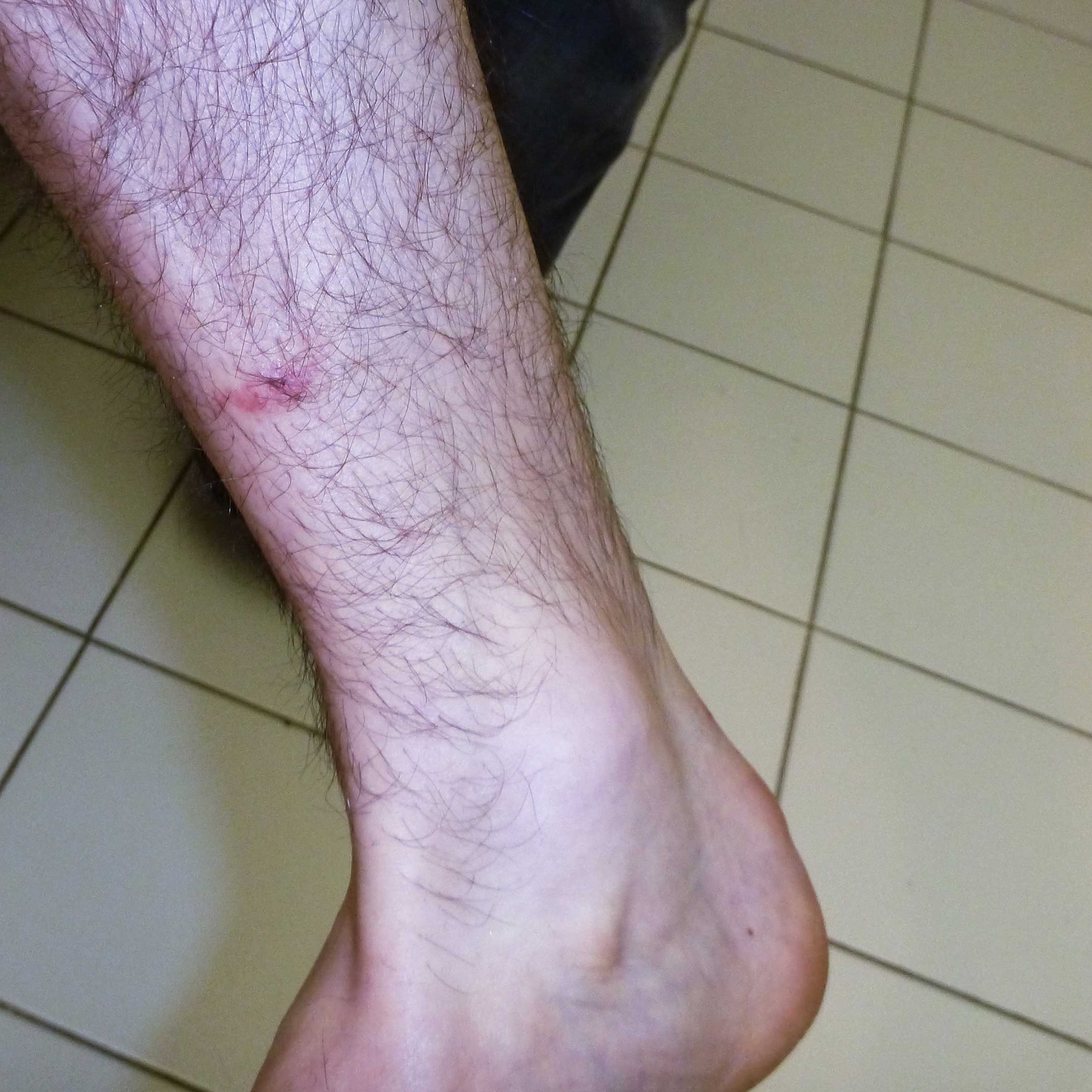 bed bug bite pictures images