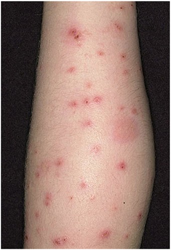 bed bug bite images on humans - pictures, photos