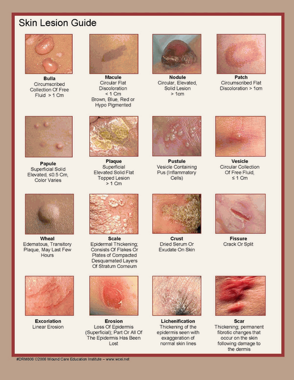 skin-lesions-descriptions-pictures-photos