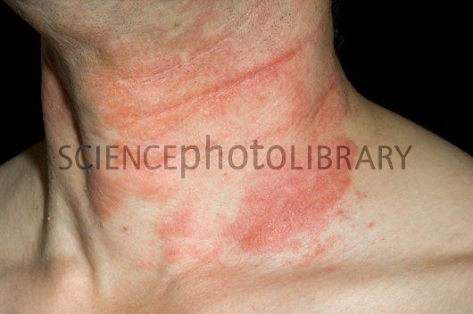 Hypothyroid Dry Skin Pictures Photos 2022