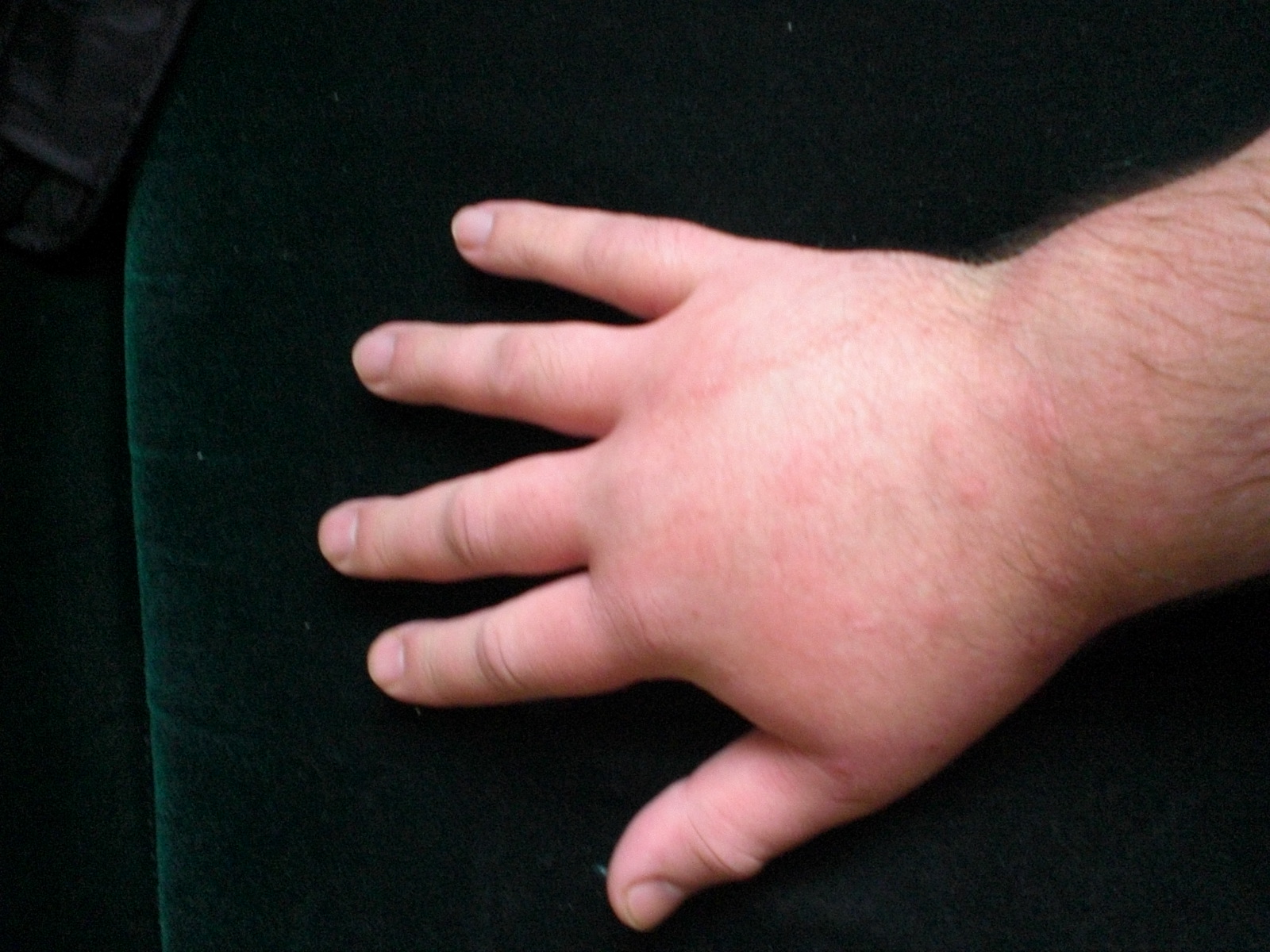 swollen-itchy-hands-pictures-photos