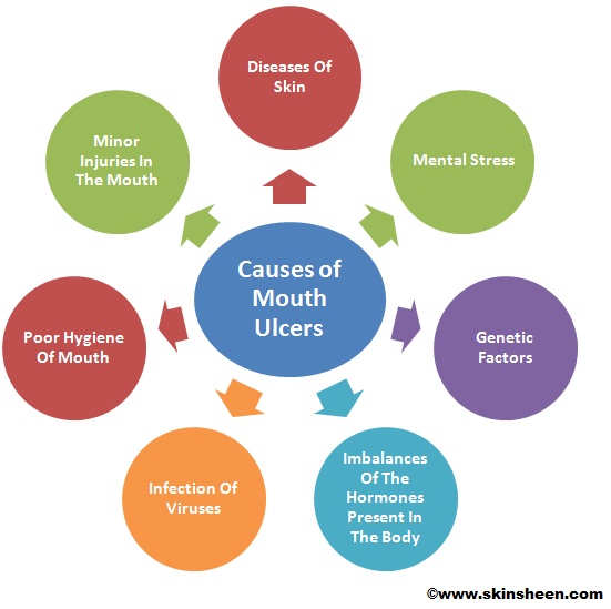 what causes mouth ulcer - pictures, photos