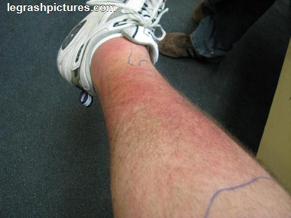 Diabetes Rashes On Legs Pictures Photos