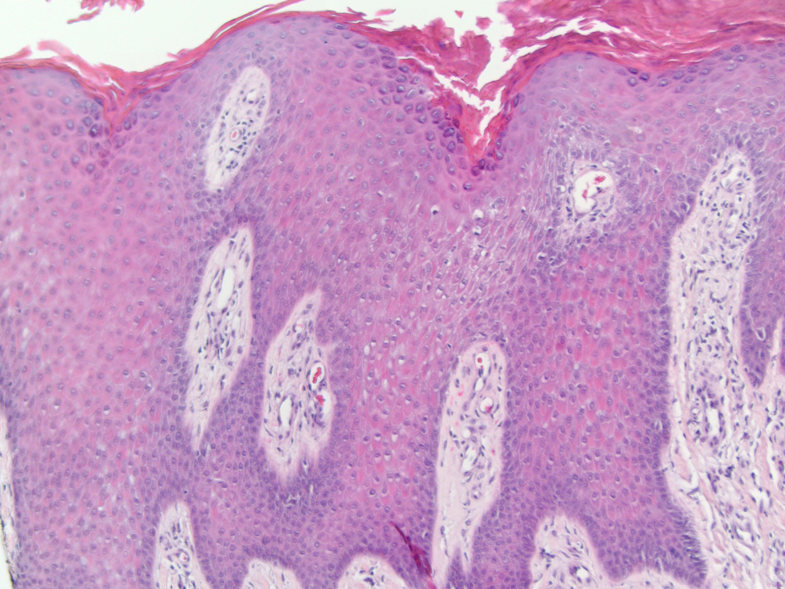 Spongiotic Dermatitis Histology