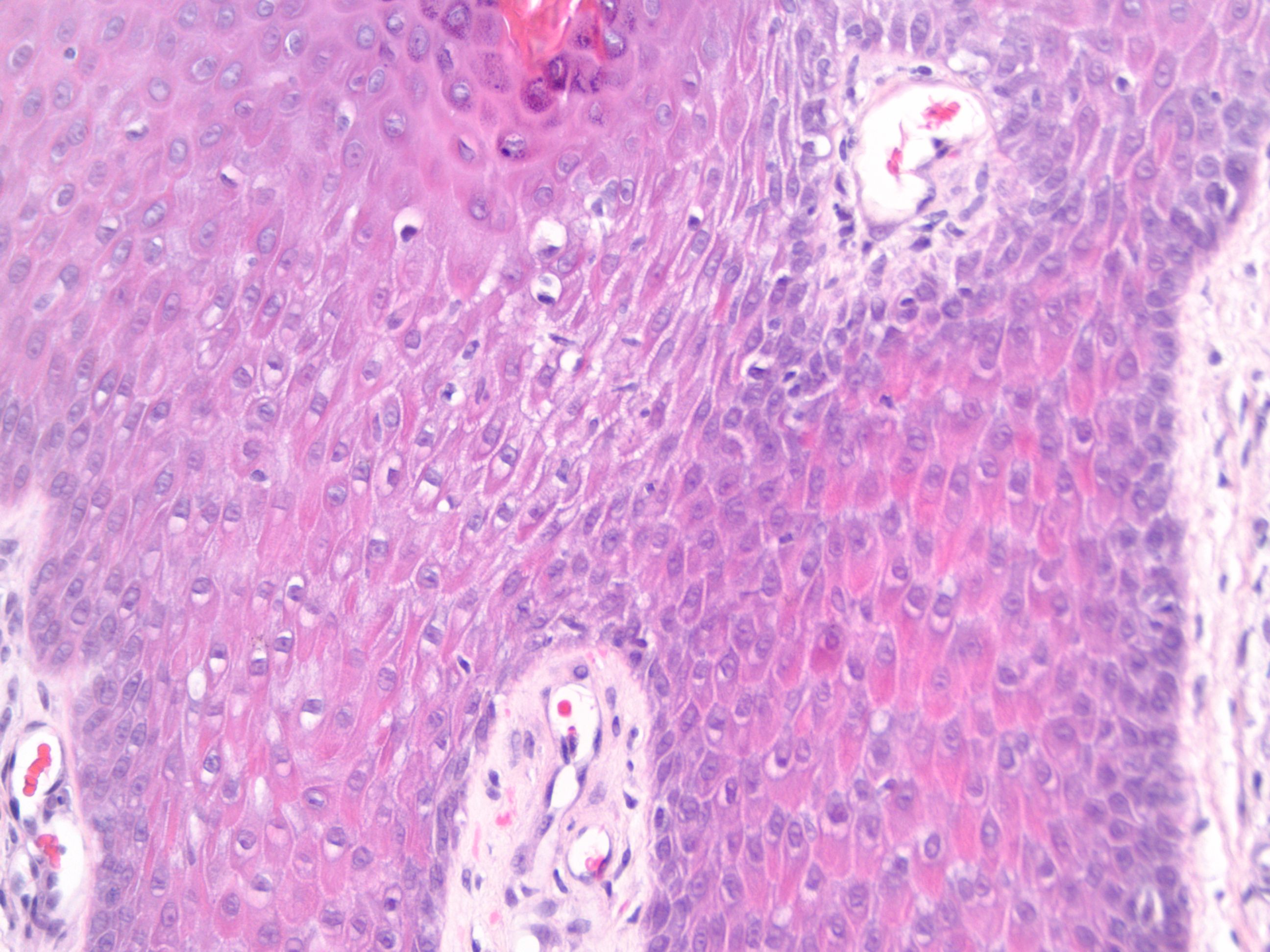 Spongiotic Dermatitis Histology