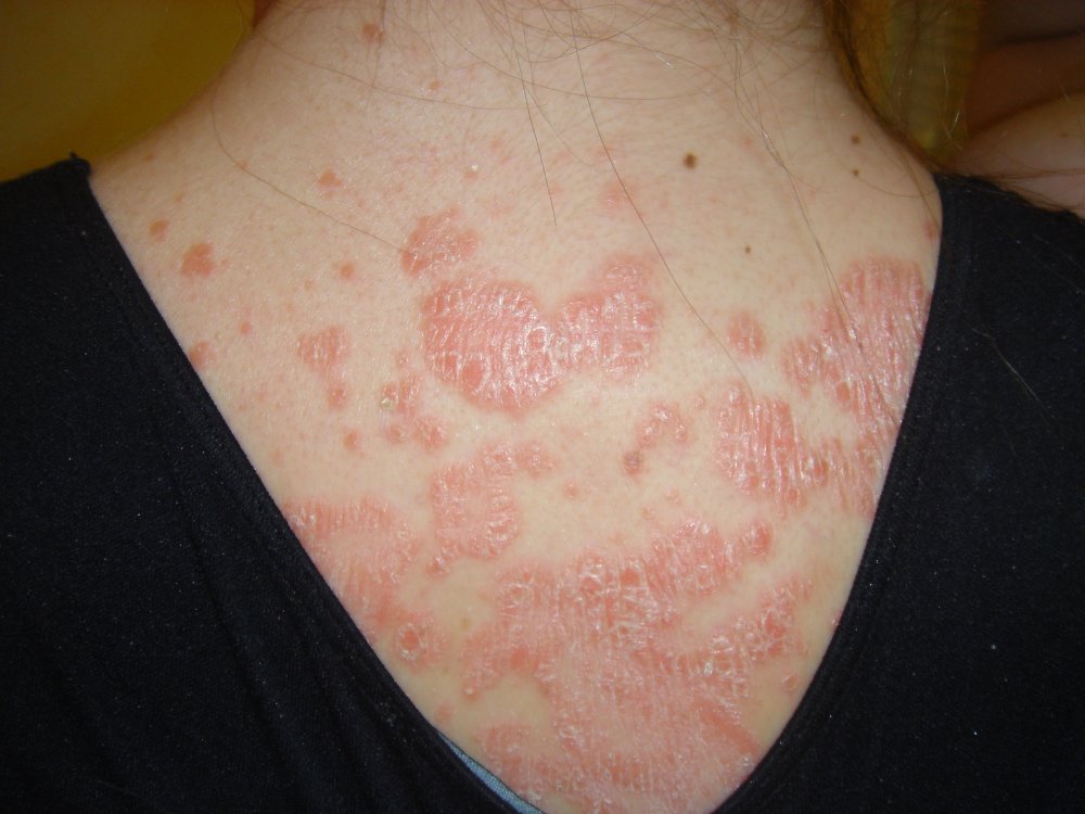 Itchy Bumps On Neck Pictures Photos