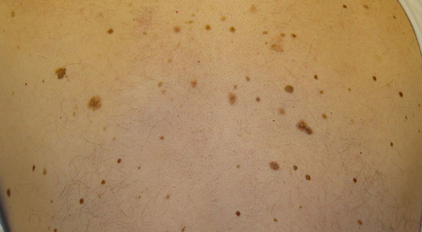 skin disorders list - pictures, photos