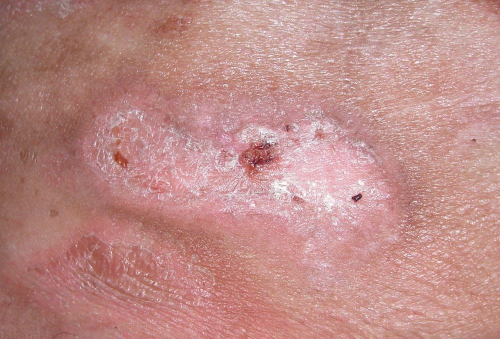 cutaneous-lymphoma-pictures-photos