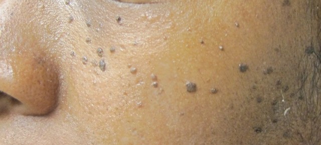 dermatosis papulosa nigricans - pictures, photos