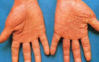 Dry Skin On Palms - Pictures, Photos