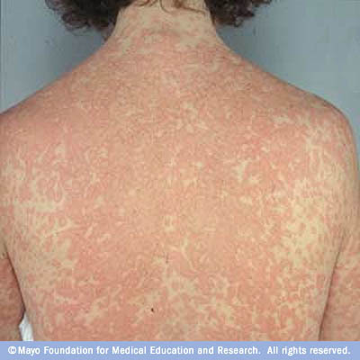 rash caused by antibiotics - pictures, photos