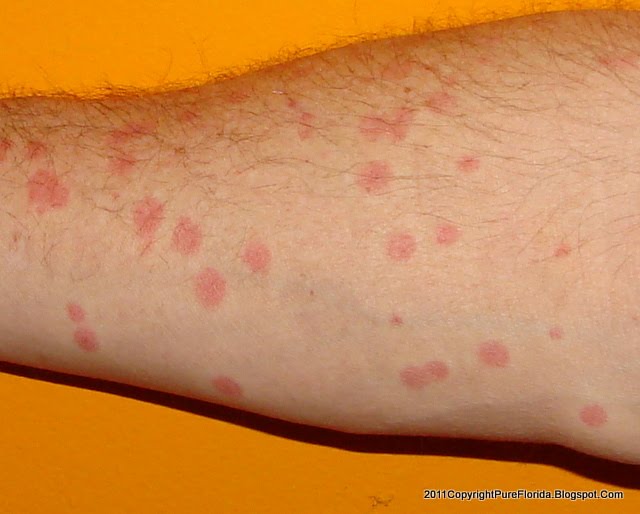 reasons-and-therapies-for-red-dots-on-your-legs-holistic-health-red