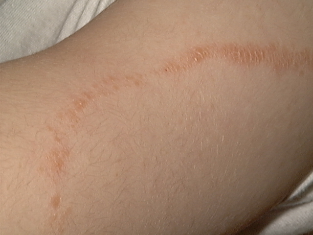 skin rashes that itch lines