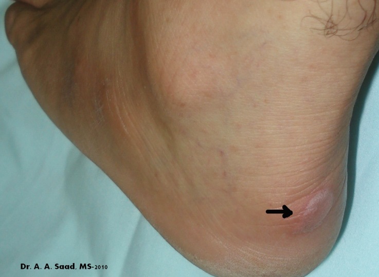 friction blister - pictures, photos