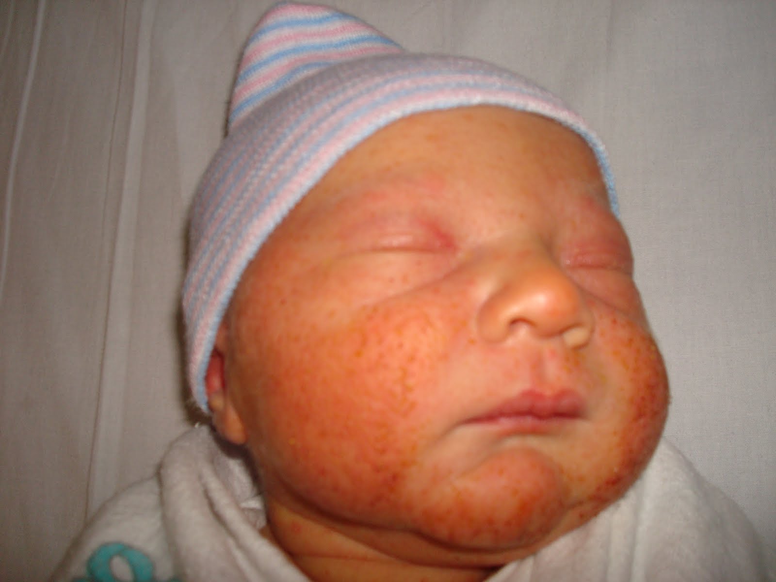 newborn-hives-pictures-photos