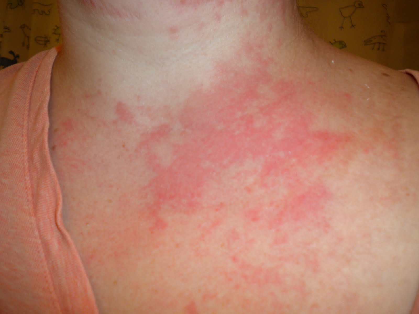  rash  on sides  of torso pictures photos