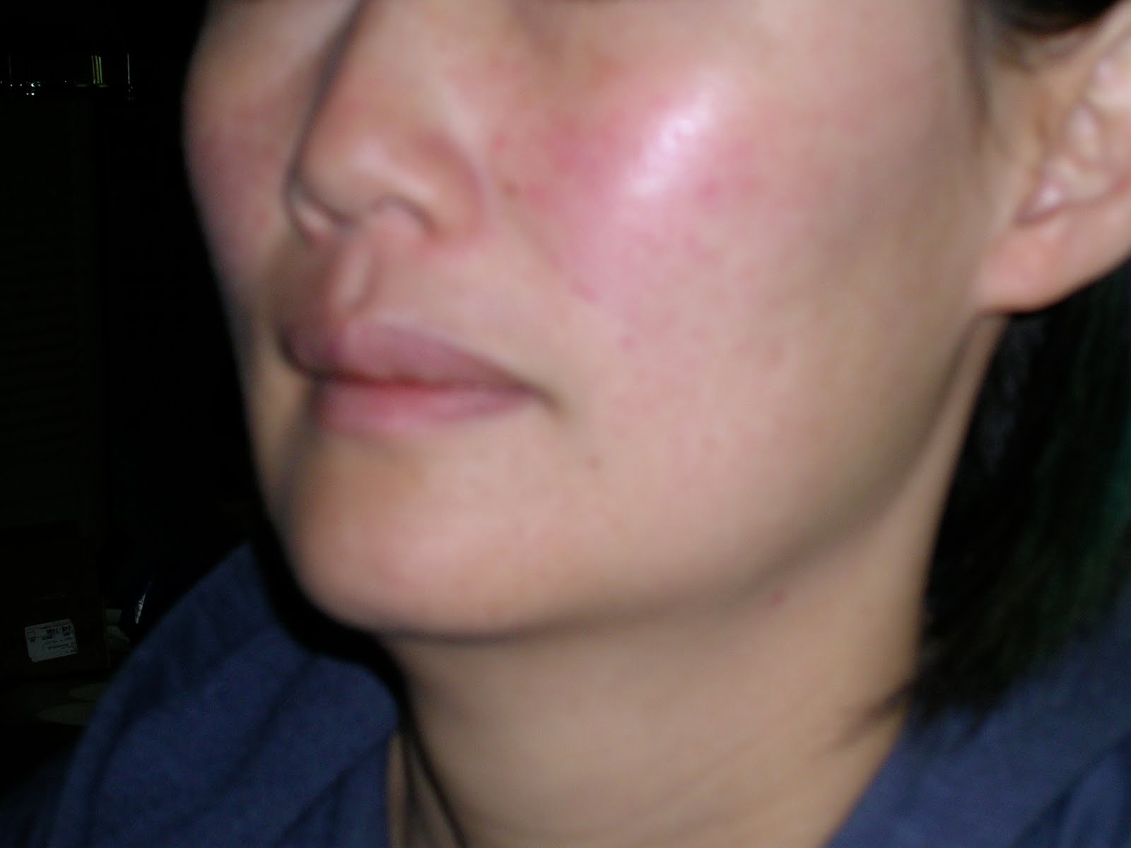 mild-rosacea-on-face-pictures-photos