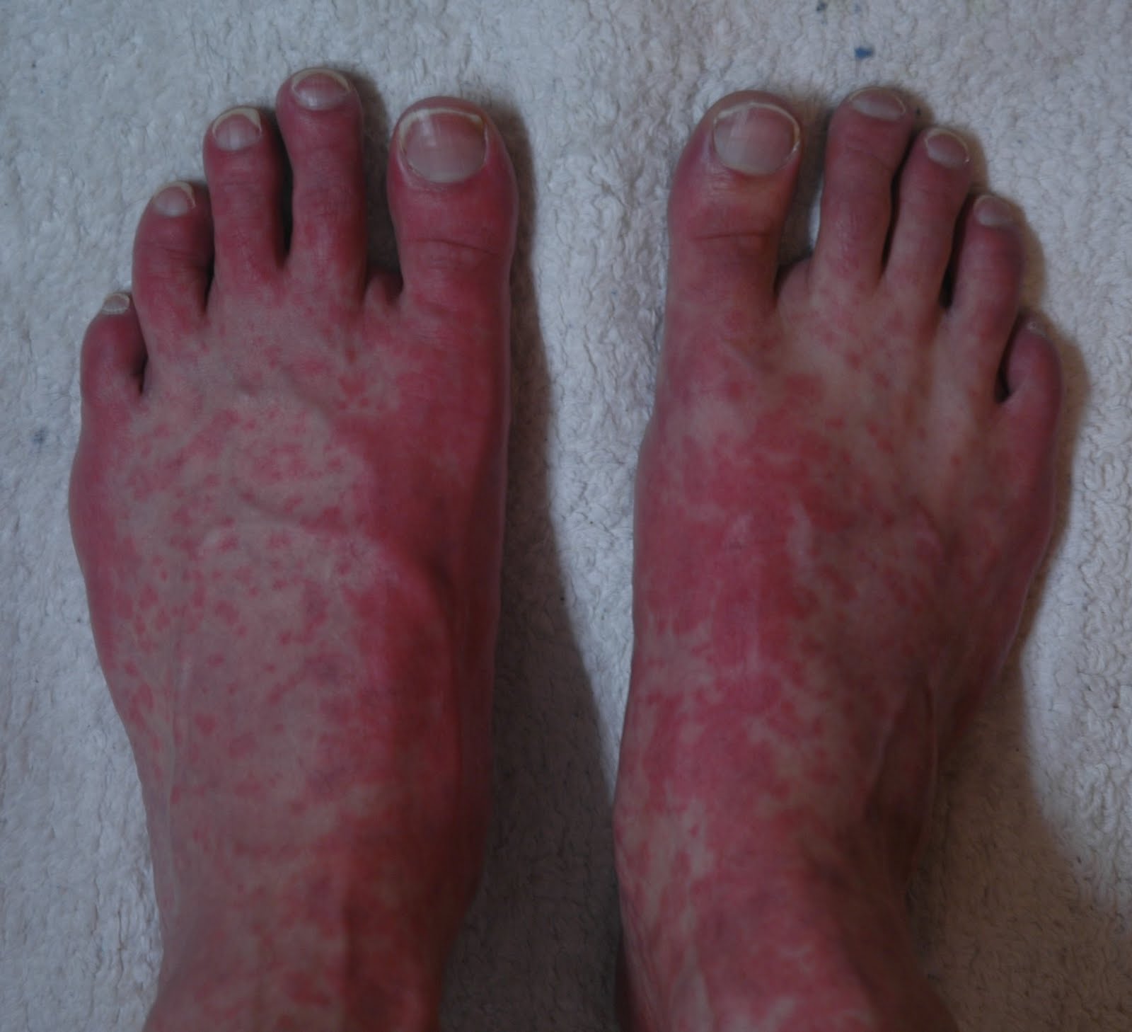 Heat Rash On Top Of Feet Pictures Photos