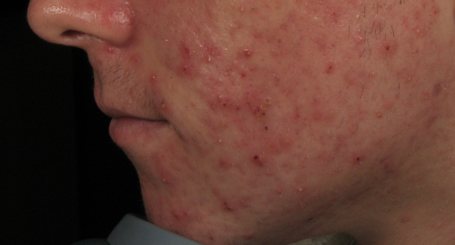 Acne Inflammatory Pictures Photos