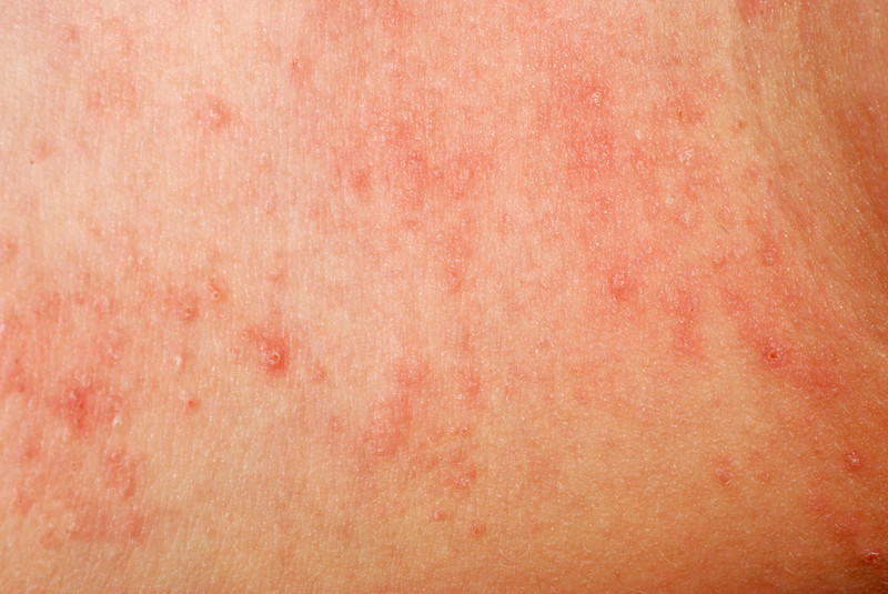 dermatitis rash - pictures, photos