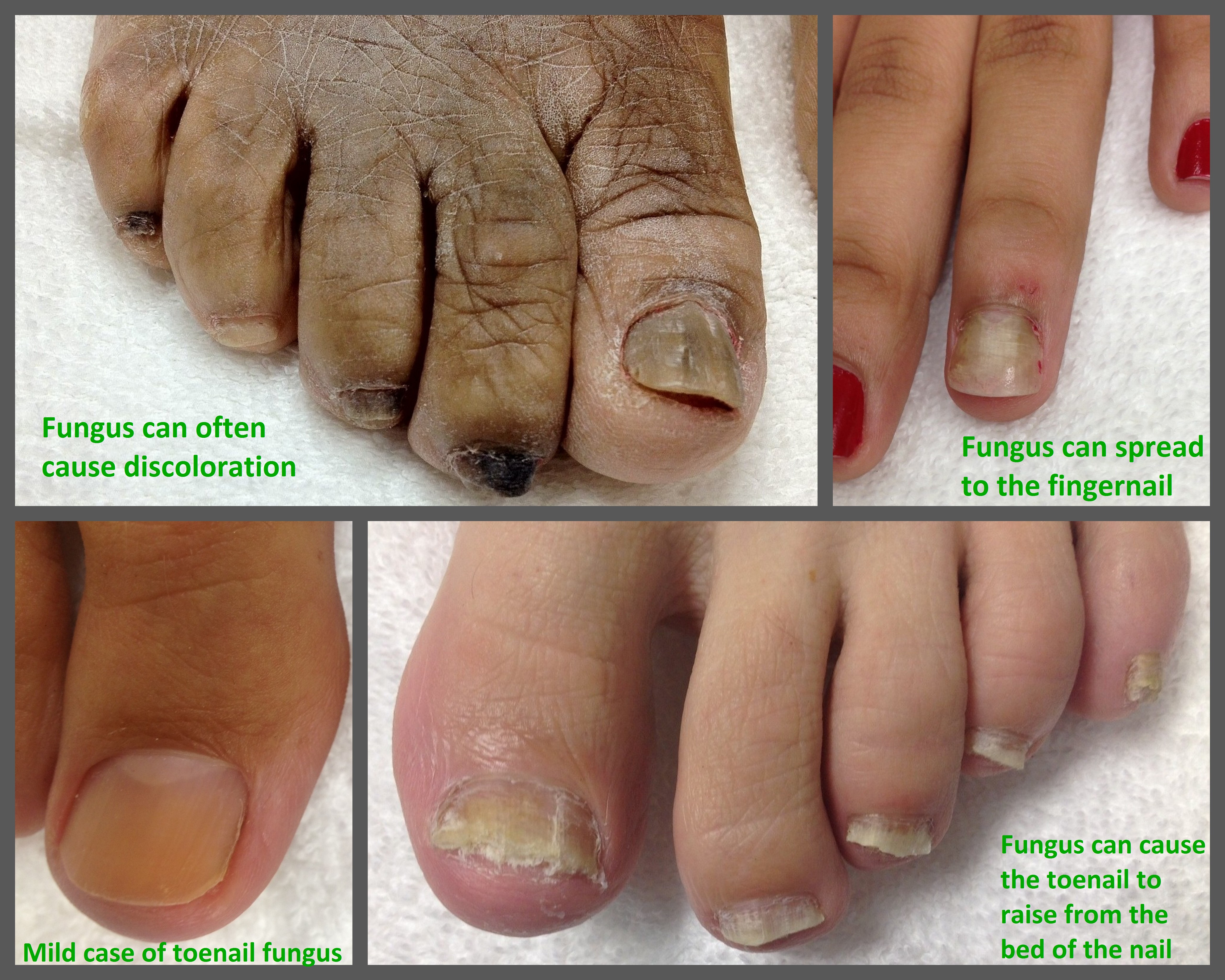 different types of foot fungus - pictures, photos