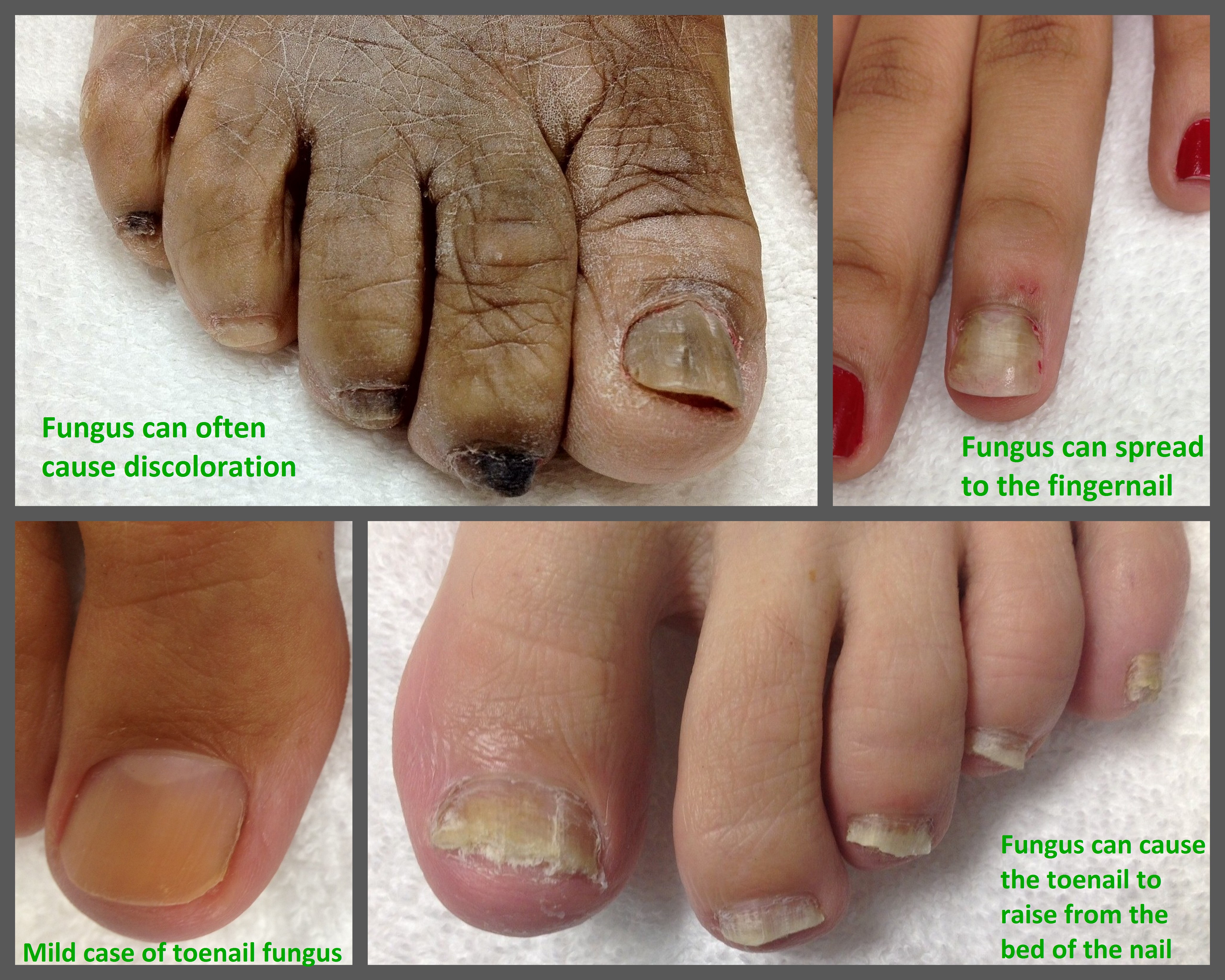 black-toenail-fungus-know-the-causes-treatment-and-home-remedies