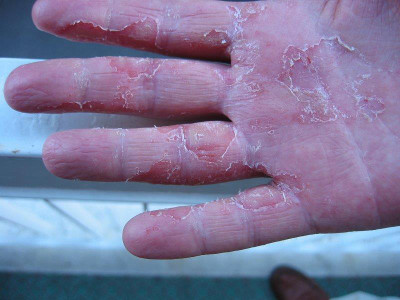 dyshidrosis treatment - pictures, photos