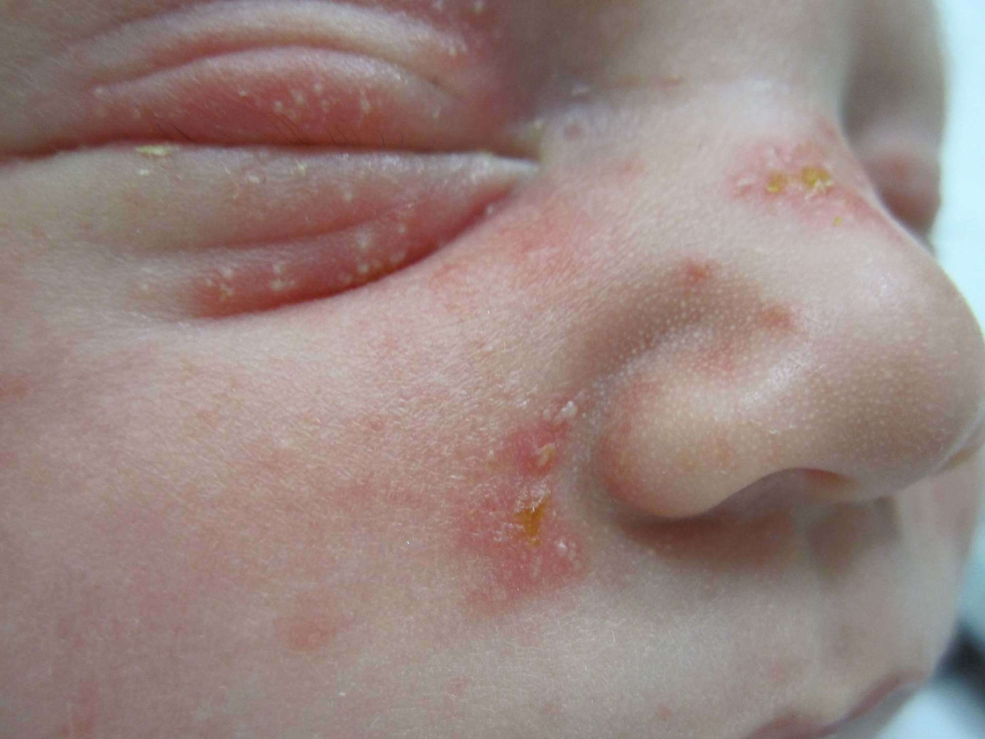neonatorum toxicum pictures, photos