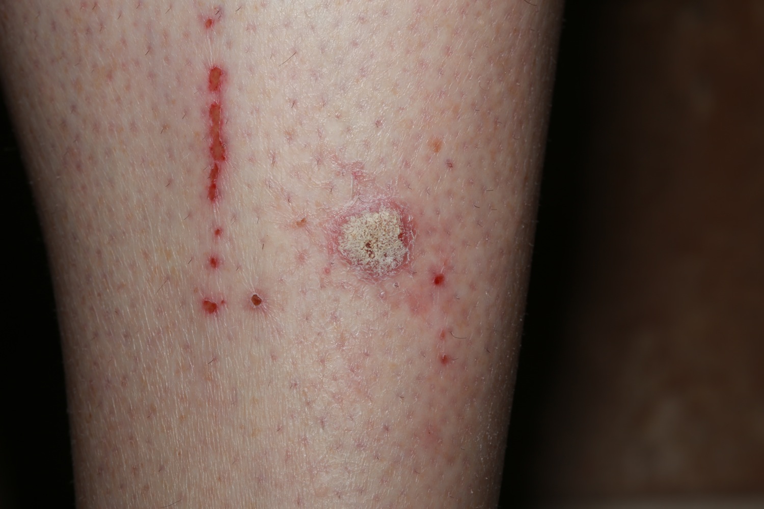 Excoriations Pictures Photos