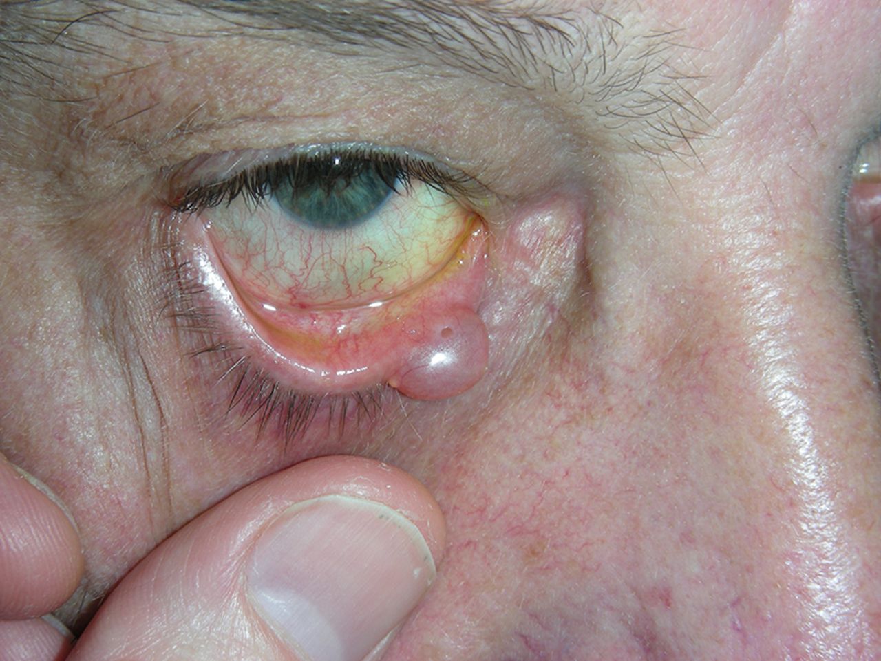swollen yellow eyeball