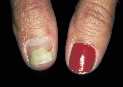 distal onycholysis - pictures, photos