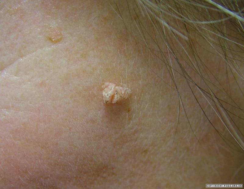 viral warts pictures, photos