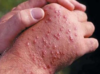 fire ant bites fire ant bites