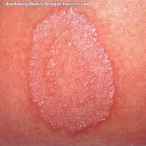 wart on arm - pictures, photos