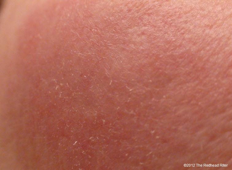 small-dry-bumps-on-skin-possible-causes-diy-cosmetics