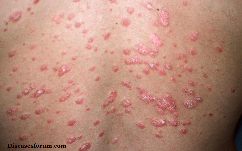 Guttate psoriasis causes 