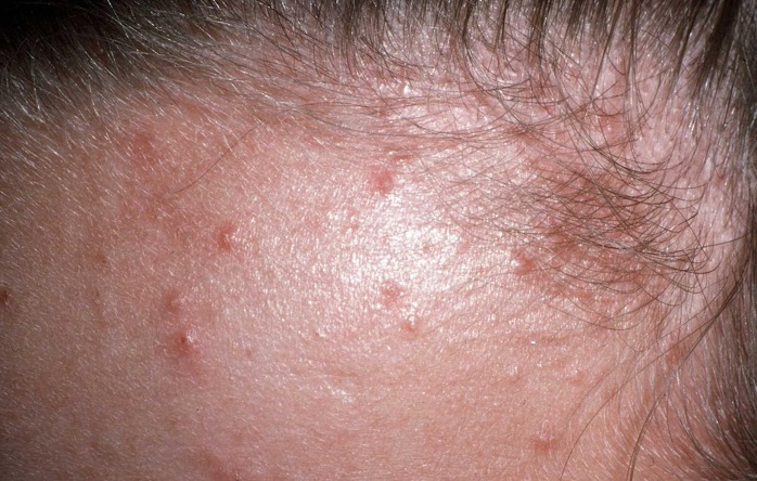 follicle infection - pictures, photos