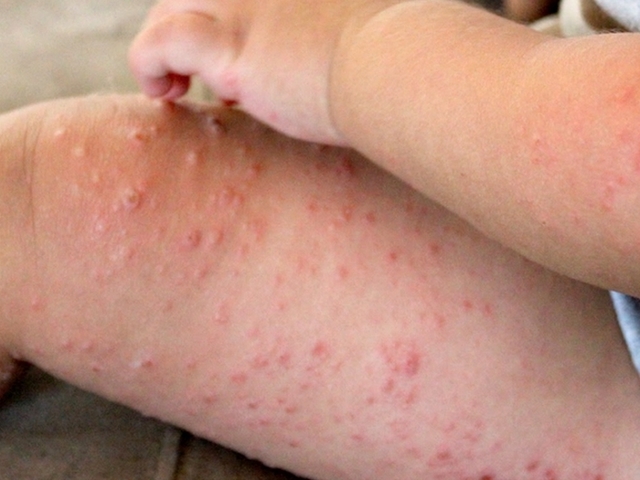 hand-foot-and-mouth-disease-rash-pictures-photos