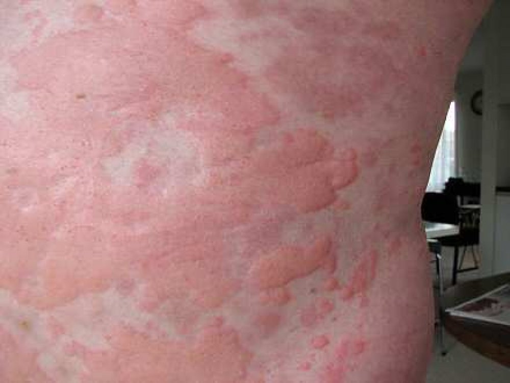 photos of hives on skin