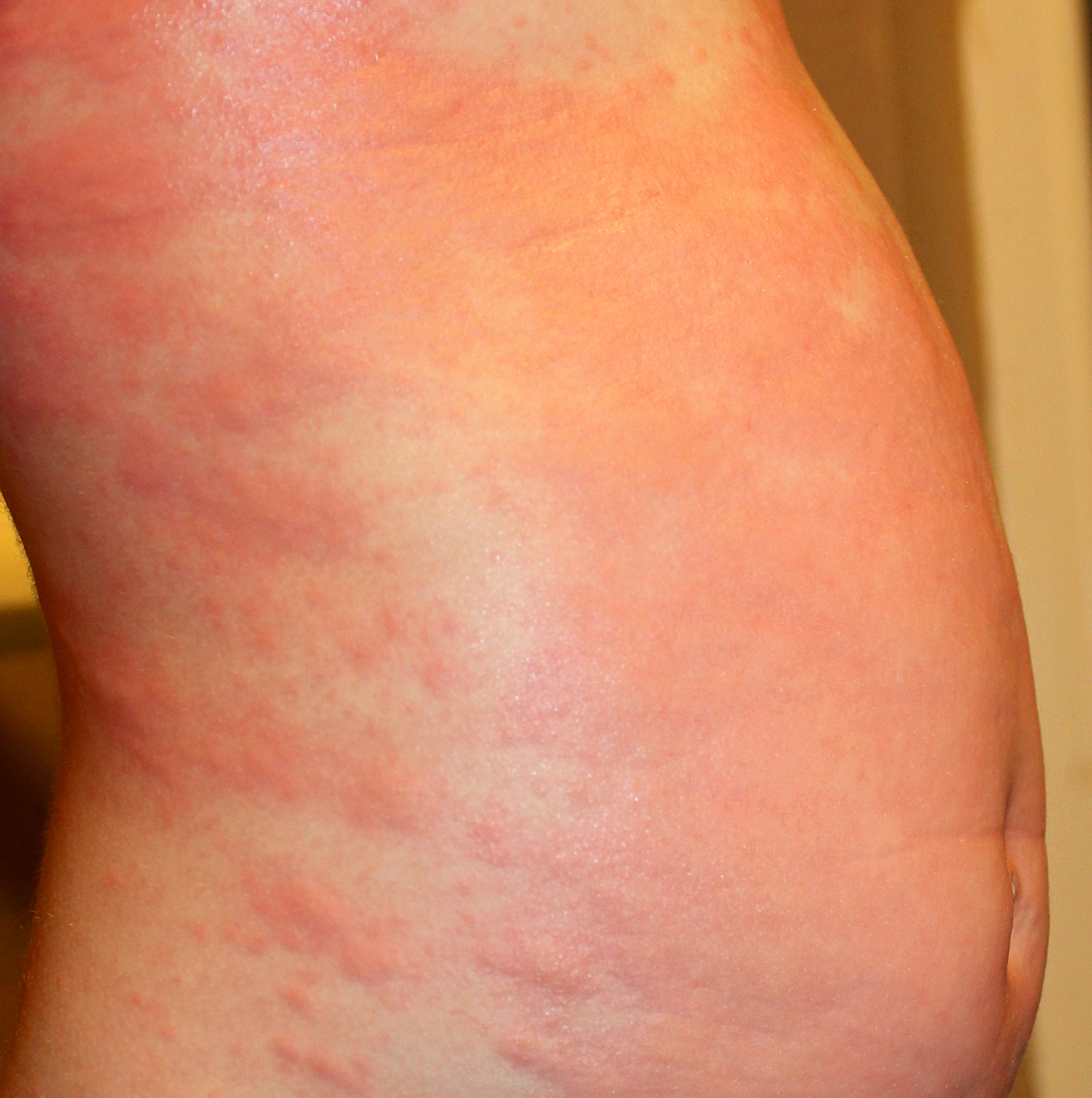Urticaria Hives In Children Symptoms Rash Causes Treatment Images