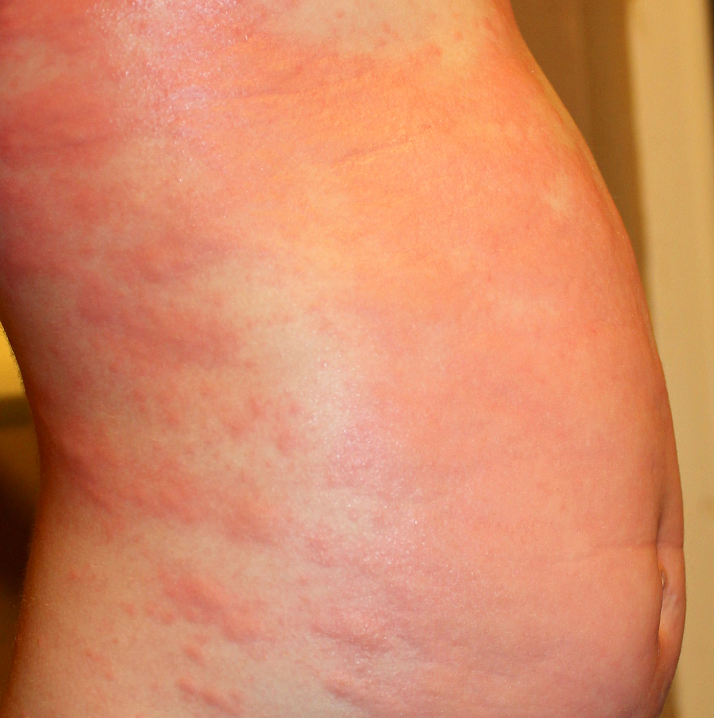 urticaria-hives-in-children-symptoms-rash-causes-treatment-images